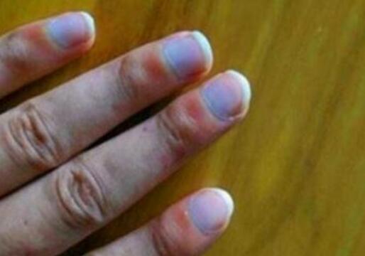 什么是林賽氏指甲?林賽氏指甲是尿毒癥嗎?